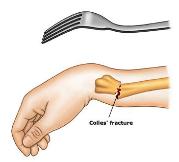dinner fork colles fracture